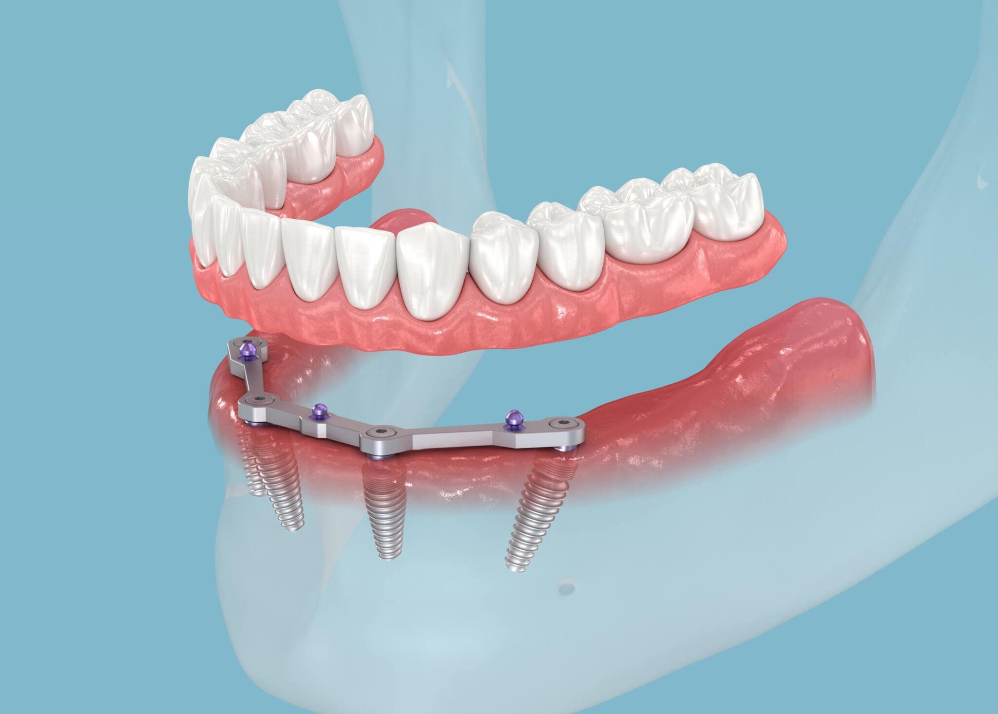 All-on-4 İmplant 1 All-on-4-Implant-Fiyatlari