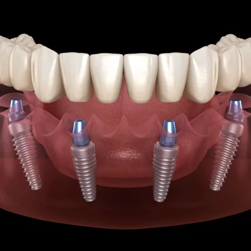 All-on-4 Implants en Turquie