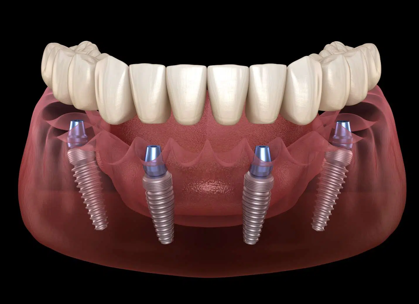Implants All-on-4 en Turquie 1 All-on-4 Implants en Turquie