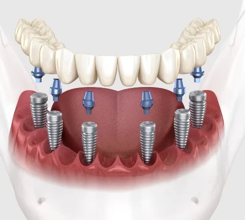 All-on-6-Implant-Fiyatlari-2024