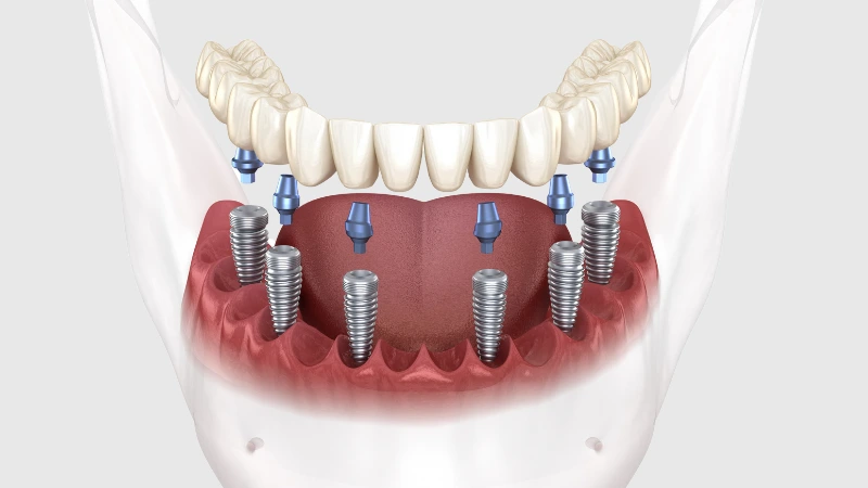 All-on-6-Implant-Fiyatlari-2024