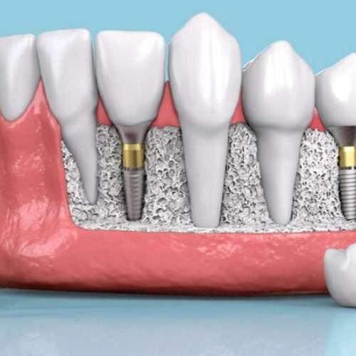 Bir-Gunde-Implant-Fiyatlari