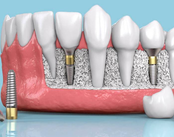 Bir-Gunde-Implant-Fiyatlari