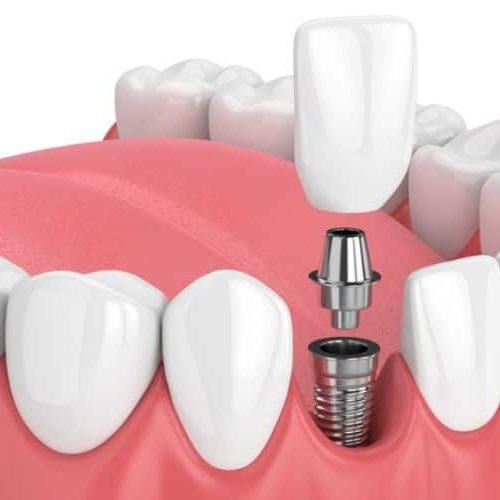 Dental-Implants-Turkey