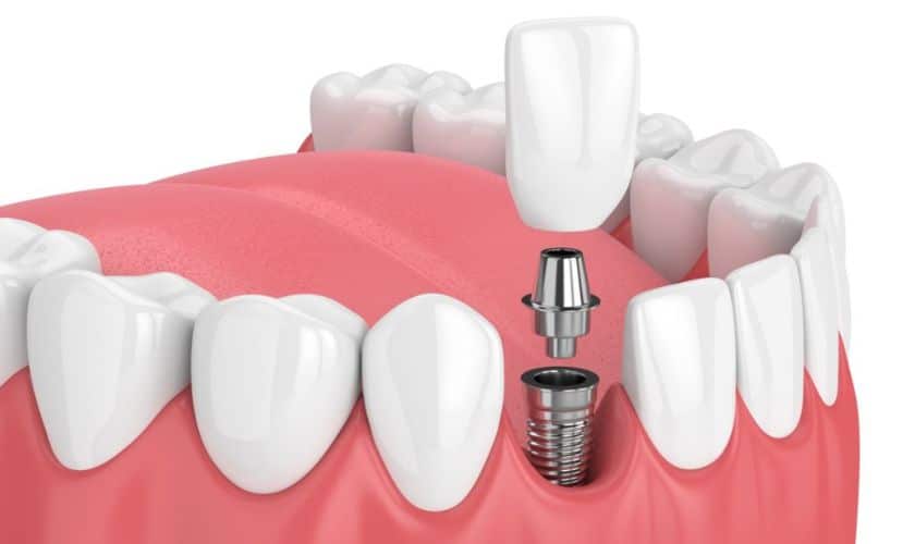 Tandheelkundige implantaten in Turkije 1 svg+xml;charset=utf