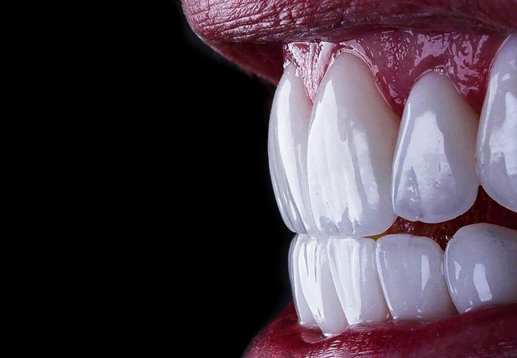 Emax-Veneers-in-der-Turkei