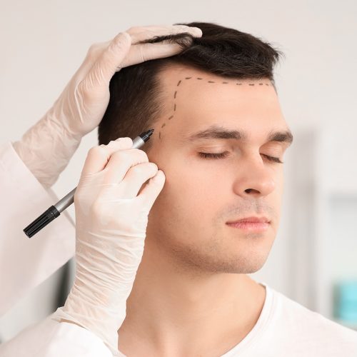 FUE-Haartransplantation-in-der-Turkei