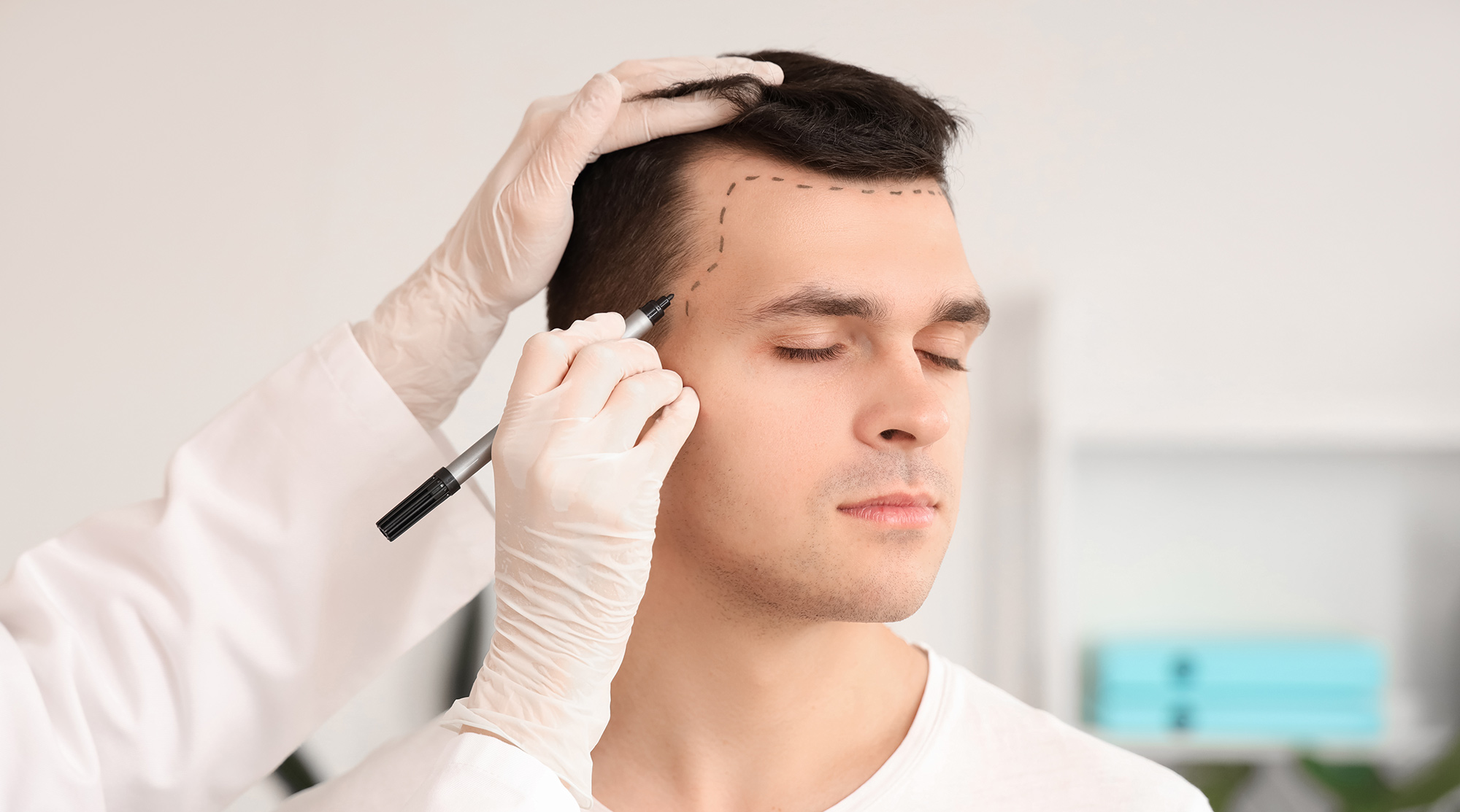 FUE-Haartransplantation in der Türkei 1 FUE-Haartransplantation-in-der-Turkei
