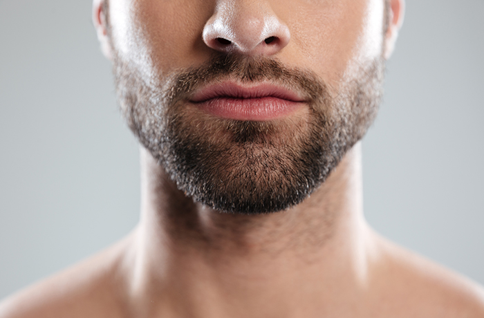 Facial Hair Transplant in Turkey 1 Facial-Hair-Transplant