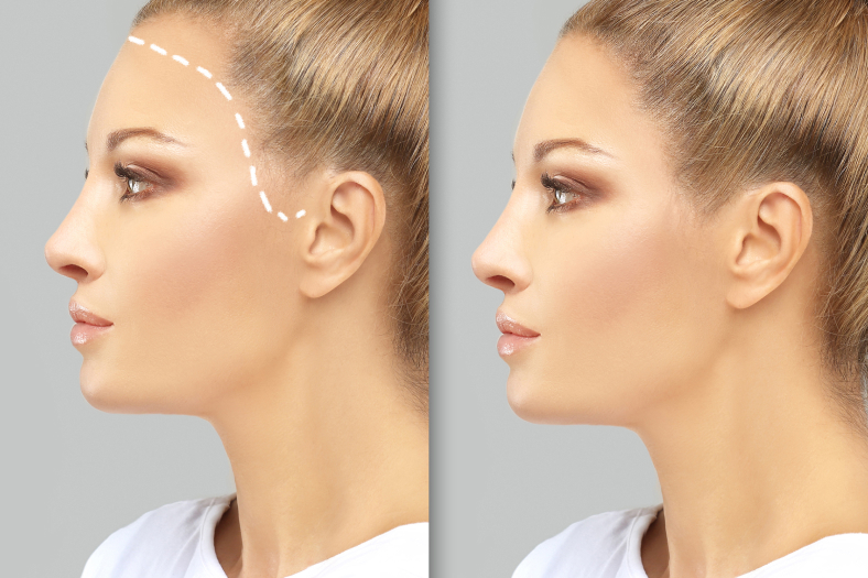 Female Hair Transplant in Turkey 1 Female-Hair-Transplant-in-Turkey