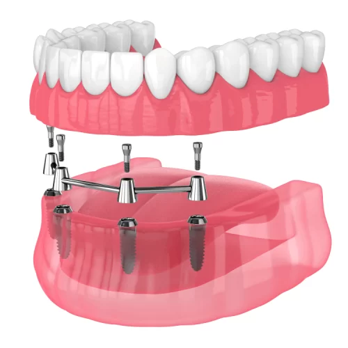 Full-Mouth-Dental-Implants