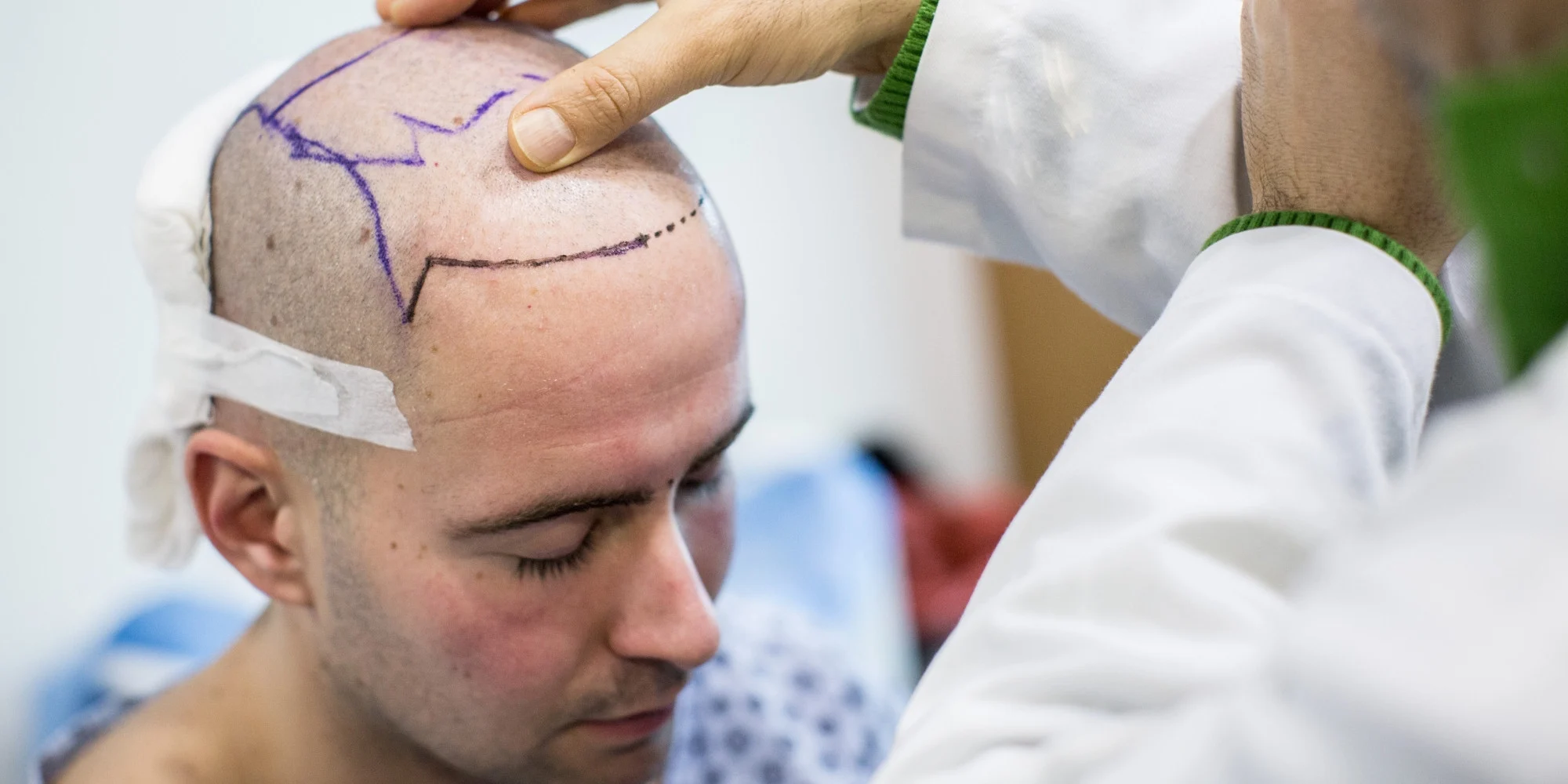 Greffe de cheveux NeoGraft en Turquie 1 Greffe-de-cheveux-NeoGraft-en-Turquie