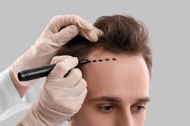 Haartransplantation-in-der-Turkei