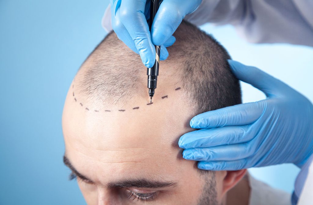 Haartransplantation-in-der-Turkei