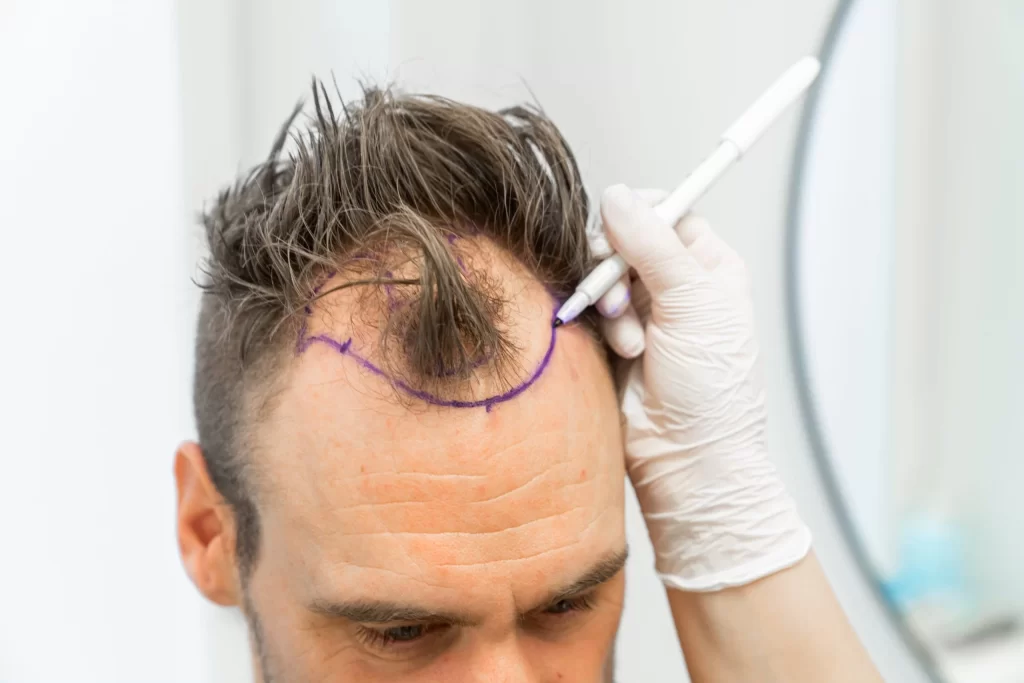 Haartransplantation-ohne-Rasur-in-der-Turkei-