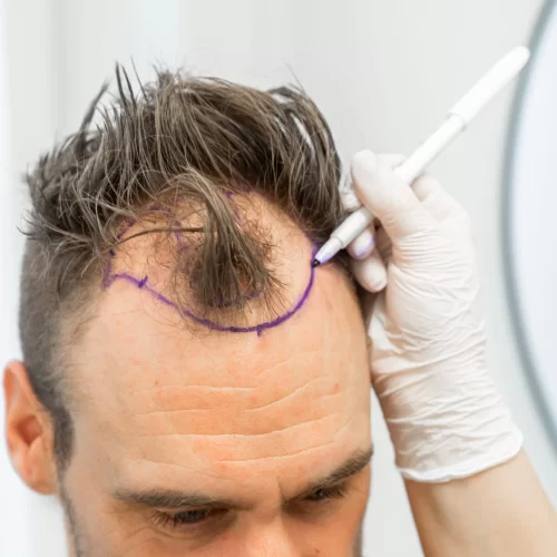 Haartransplantation-ohne-Rasur-in-der-Turkei-