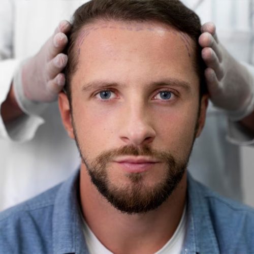 How-painful-is-a-hair-transplant