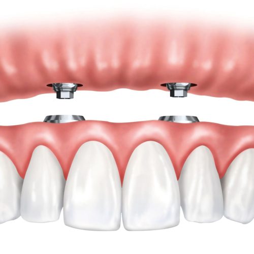 Hybrid-Prosthesis-Turkey