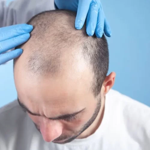 Ice FUE Haartransplantatie Turkije