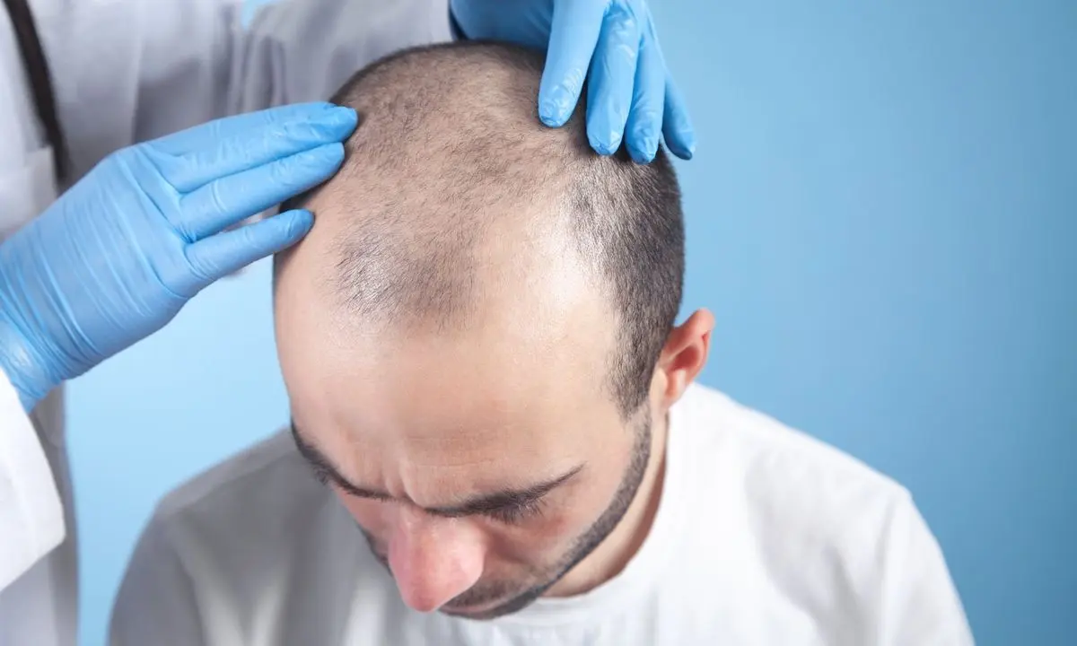 Ice FUE Haartransplantatie in Turkije 1 Ice FUE Haartransplantatie Turkije