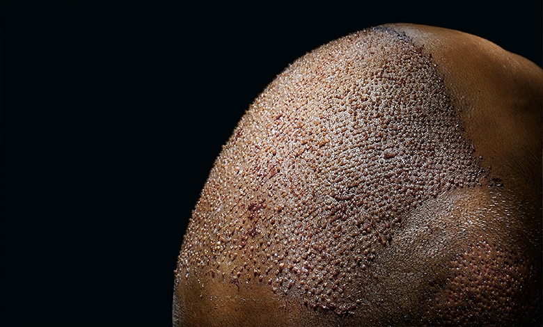 Ice FUE Haartransplantation in der Türkei 1 Ice-FUE-Haartransplantation