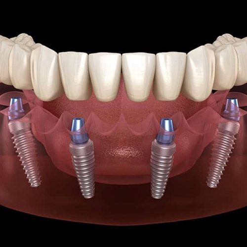 Impianti Dentali All-On-4