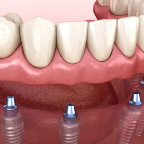 Impianti dentali a bocca intera Turchia