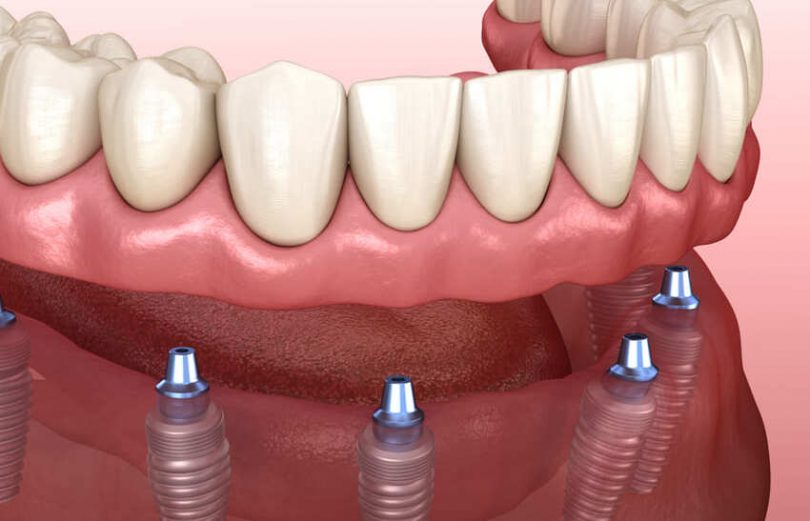 Impianti dentali a bocca intera Turchia