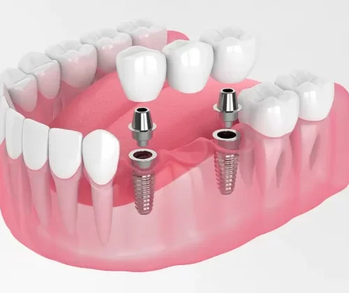 Impianti dentali in Turchia