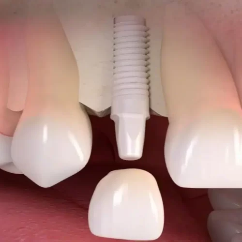 Gli impianti dentali in zirconio in Turchia offrono una soluzione avanzata, estetica e duratura per la sostituzione dei denti. Con prezzi competitivi, cure di alta qualità e una fiorente industria del turismo dentale, la Turchia è una destinazione attraente per chi cerca impianti in zirconio.