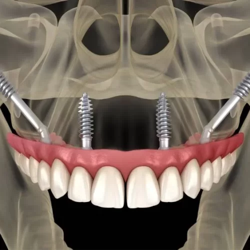 Impianti dentali zigomatici in Turchia