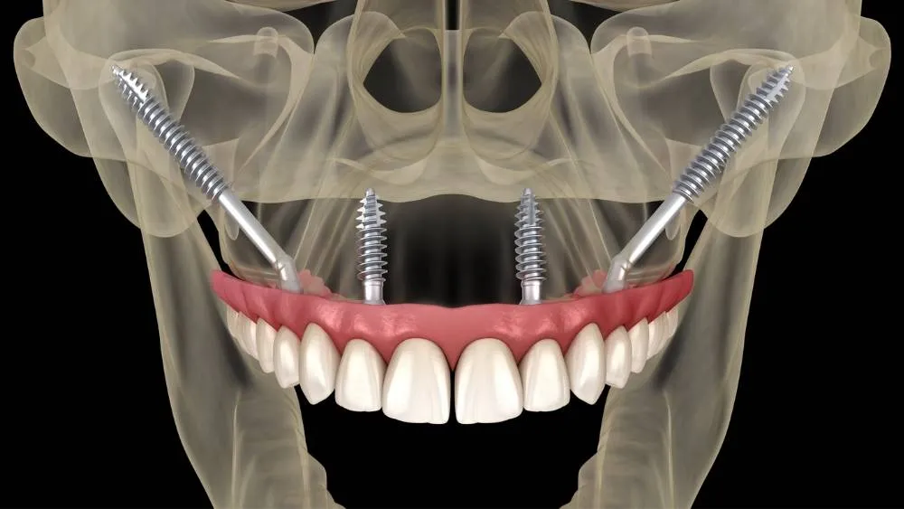 Impianti dentali zigomatici in Turchia 1 Impianti dentali zigomatici in Turchia
