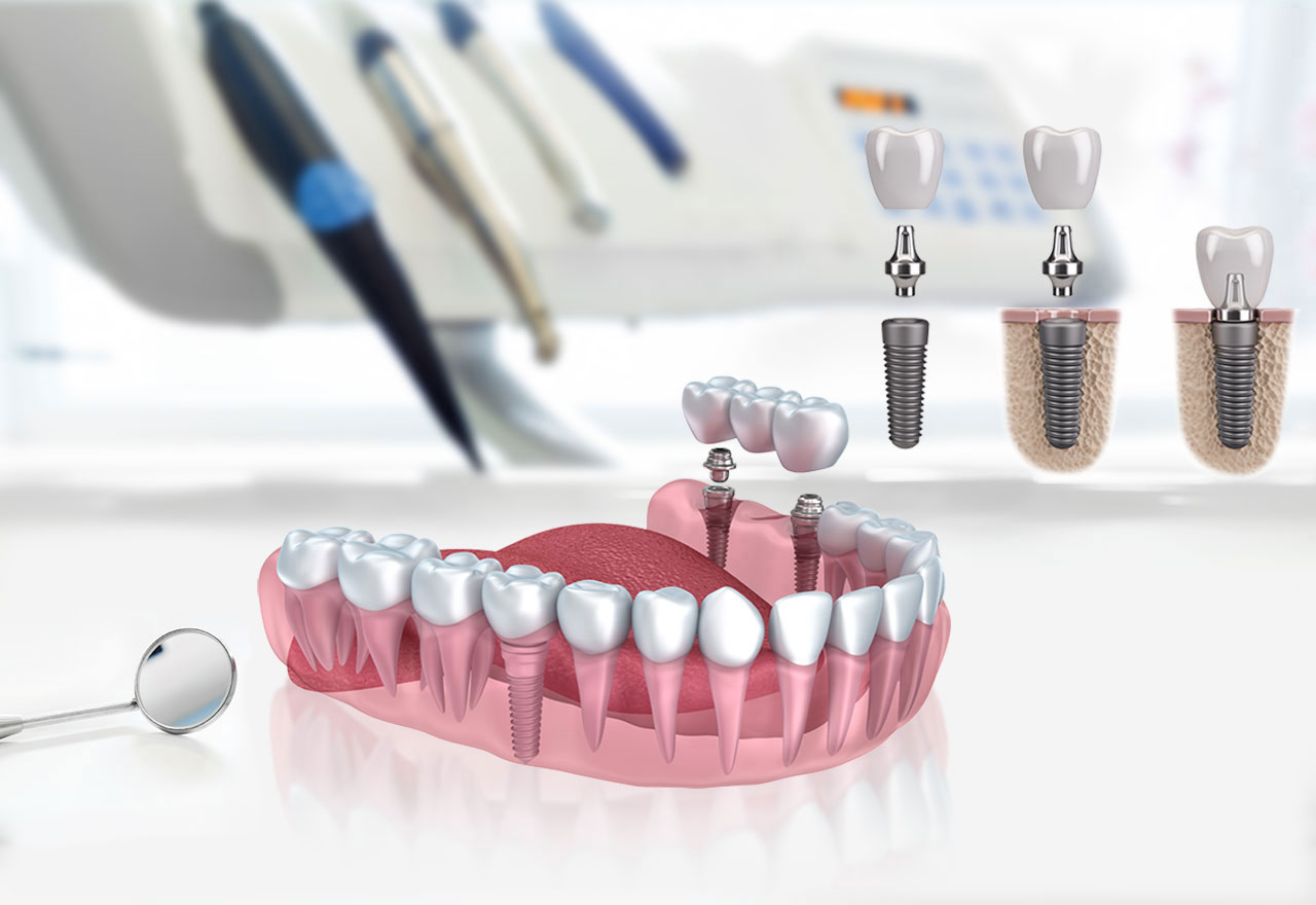 Implantation Immédiate En Turquie 1 Implant Dentaire Turquie