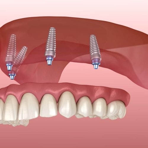 Implantes All On 4 en Turquía