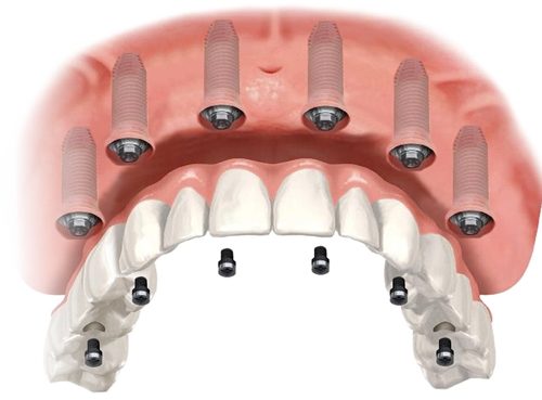 Implantes All On Six en Turquía