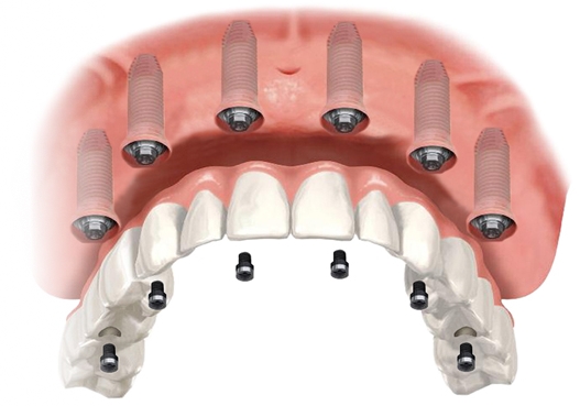 Implantes All On Six en Turquía