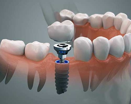 Implantes dentales de boca completa Turquía