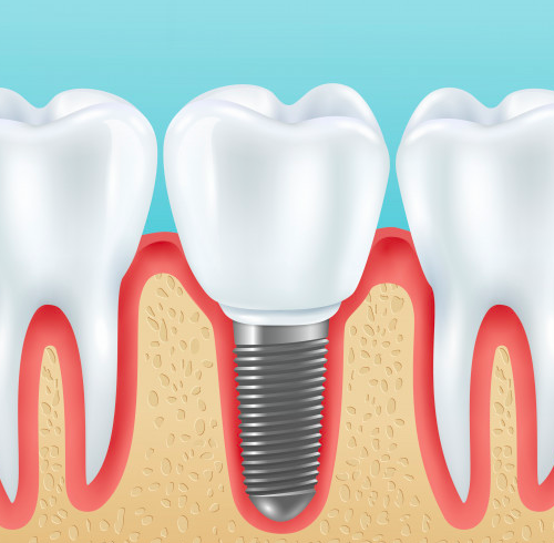 Implantes dentales de circonio en Turquía