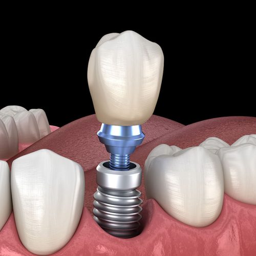 Implantes dentales sin colgajo en Turquía