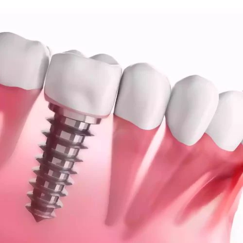 Implantes inmediatos en Turquía