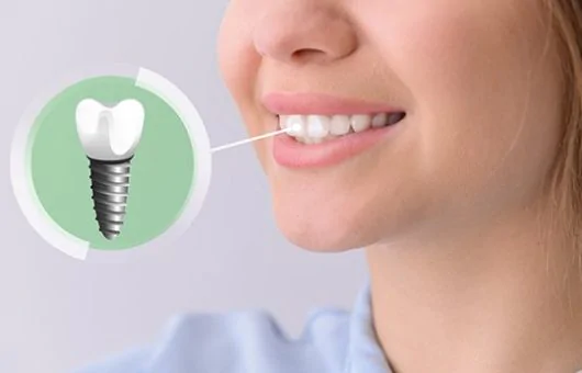 Implants dentaires en Turquie 1 Implants dentaires bouche entière Turquie