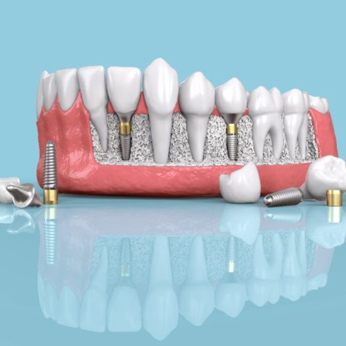 Implants-dentaires-en-zirconium-Turquie