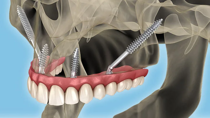 Implants zygomatiques en Turquie 1 Implants-dentaires-zygomatiques-en-Turquie