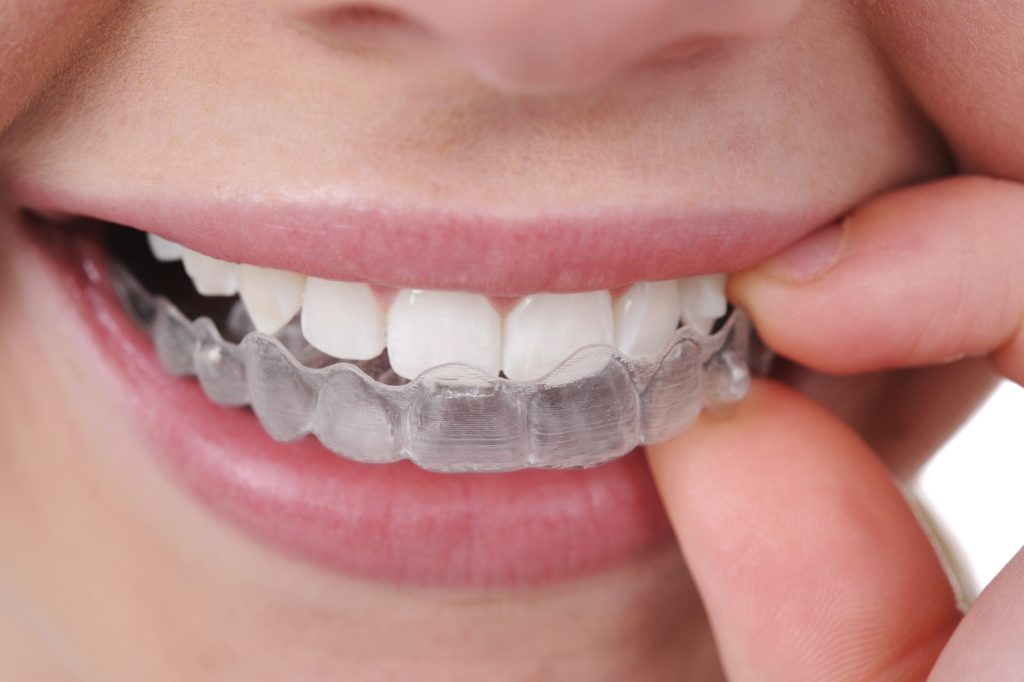 Invisalign-Tedavisi-