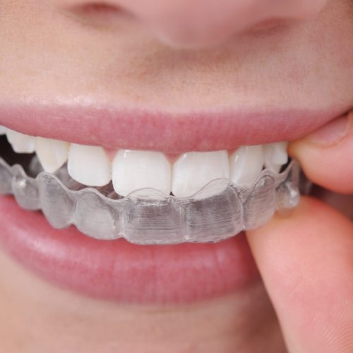 Invisalign-Tedavisi-