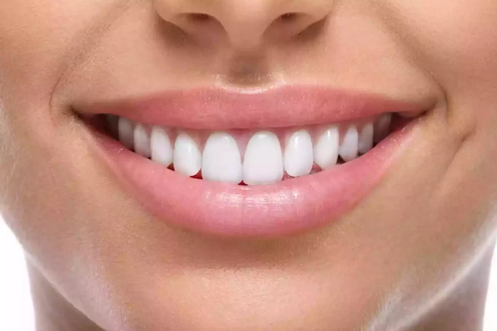 Komposit-Veneers-in-der-Turkei