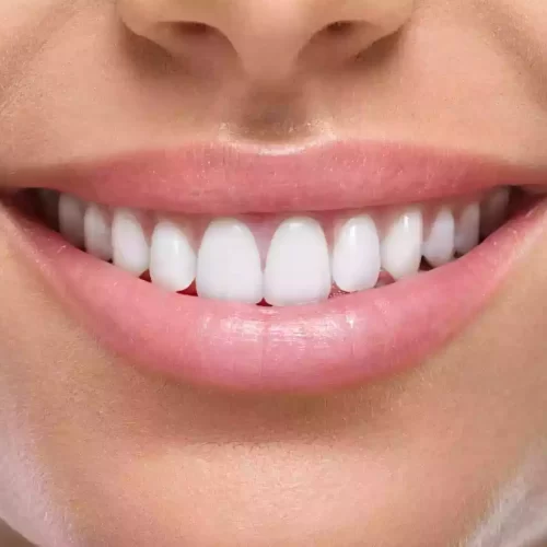 Komposit-Veneers-in-der-Turkei