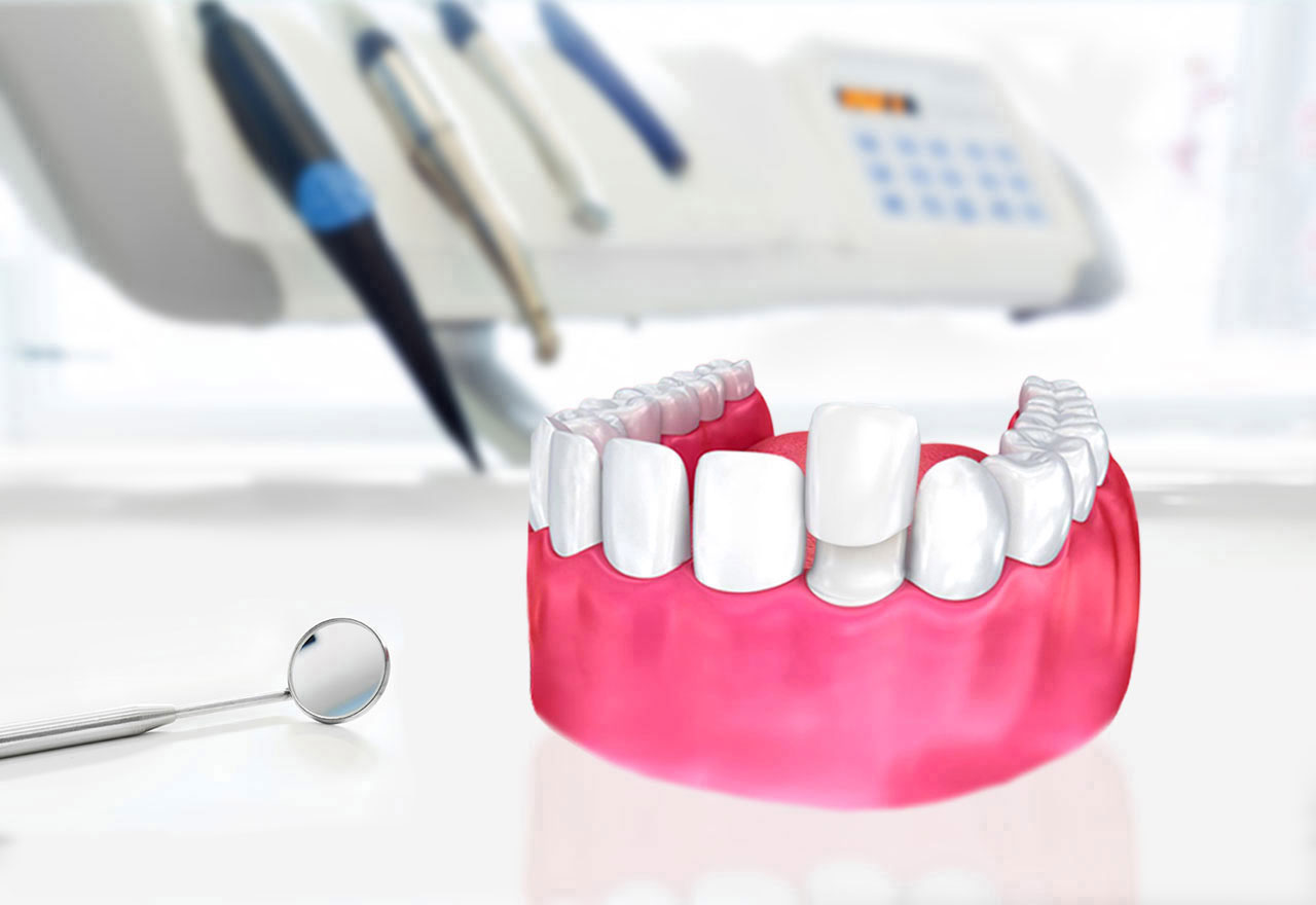 Lumineers En Turquie : Sourire Parfait à Prix Abordable, image size:1280x880