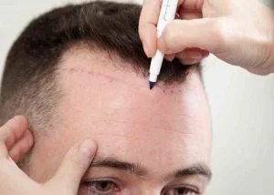 NeoGraft-Hair-Transplant-Procedure