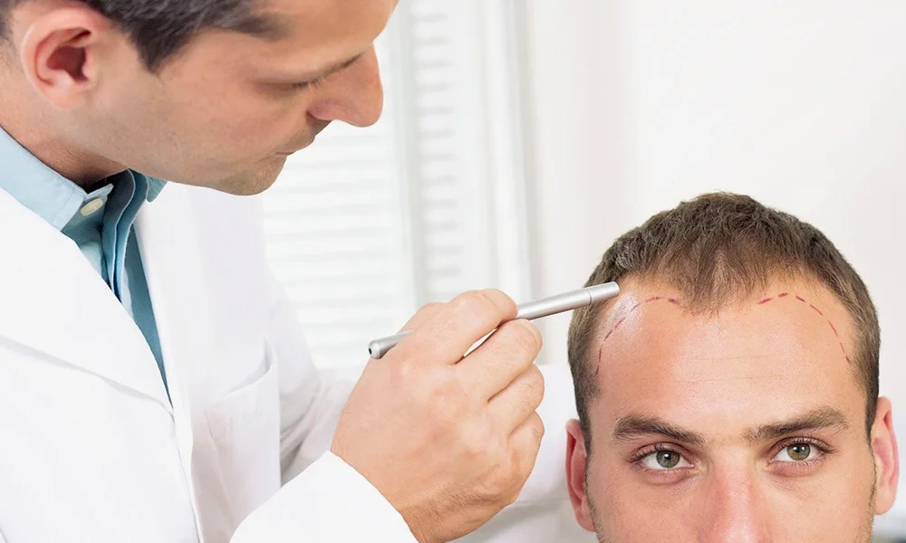 NeoGraft Hair Transplant in Turkey 1 NeoGraft-Hair-Transplant-in-Turkey